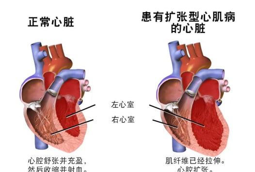 擴張性心肌病嚴重嗎