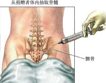 骨髓移植后需要注意什么？