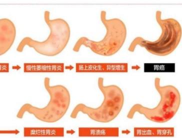 胃潰瘍出血飲食要注意些什么呢？