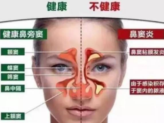 鼻竇炎跟鼻炎的區(qū)別有哪些