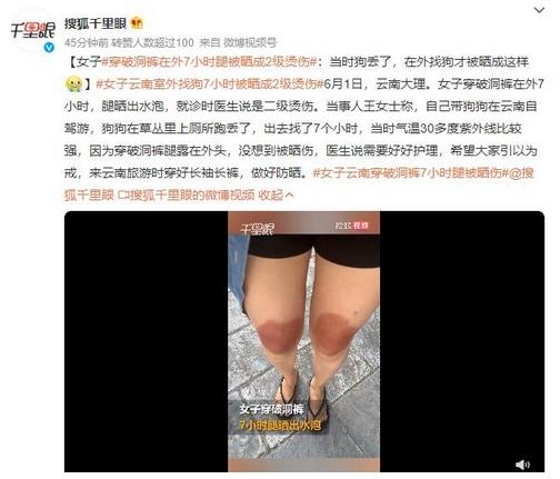 云南女子穿破洞褲7小時腿被曬傷，溫度30多度紫外線強烈